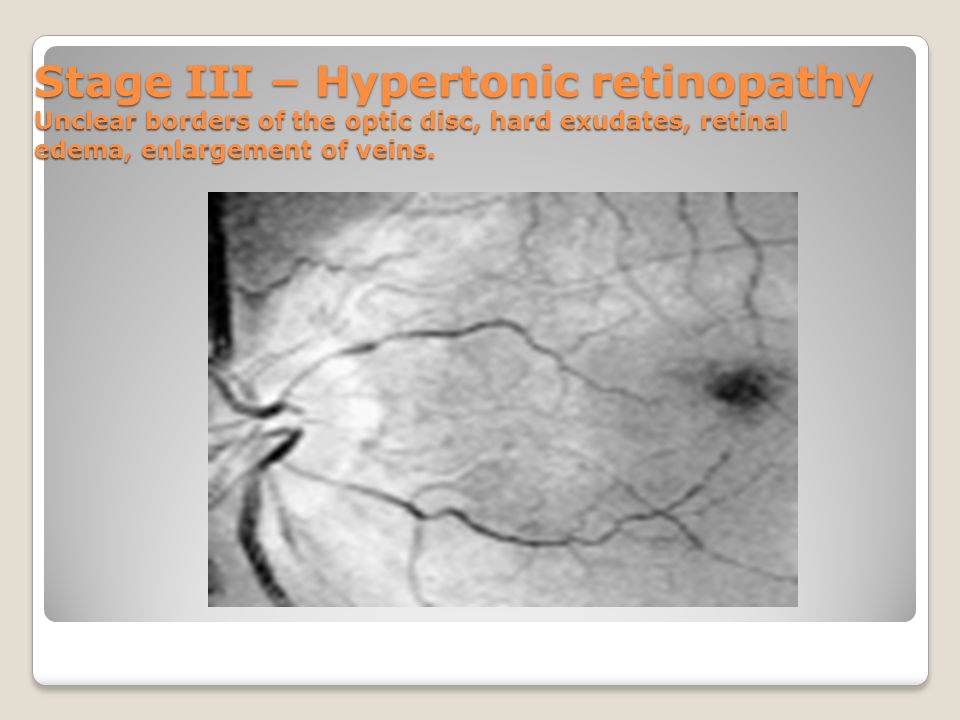 hipertónia retinopathia évelő hipertóniával